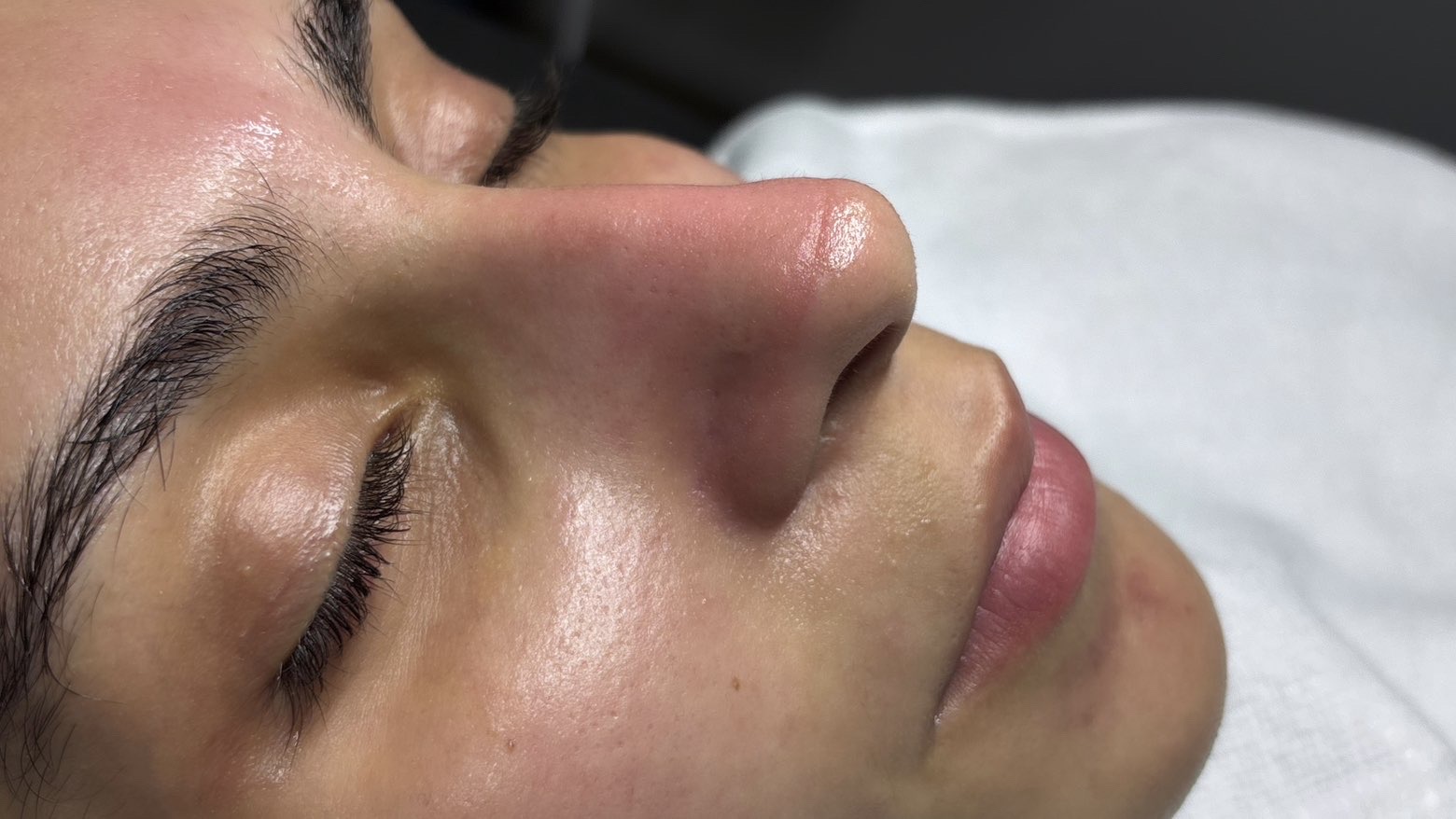 Hydrafacial — le soin du visage