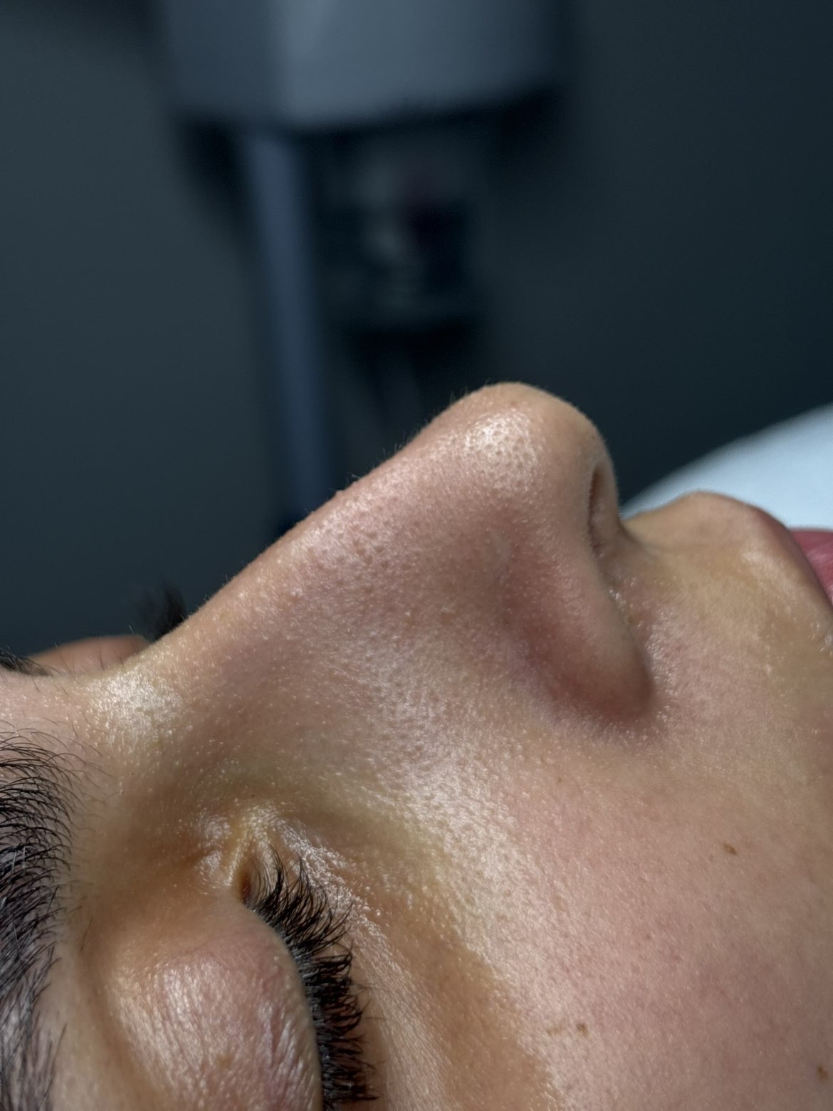 Hydrafacial — les détails de la peau